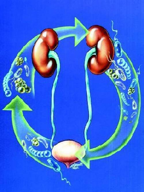 cystitis egy kisgyermek