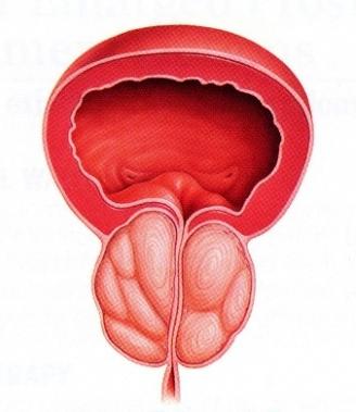 prosztata adenoma diagnózis