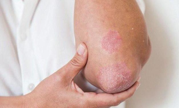 "Anti Psori Nano": az orvosok véleménye. Psoriasis Anti Psori Nano