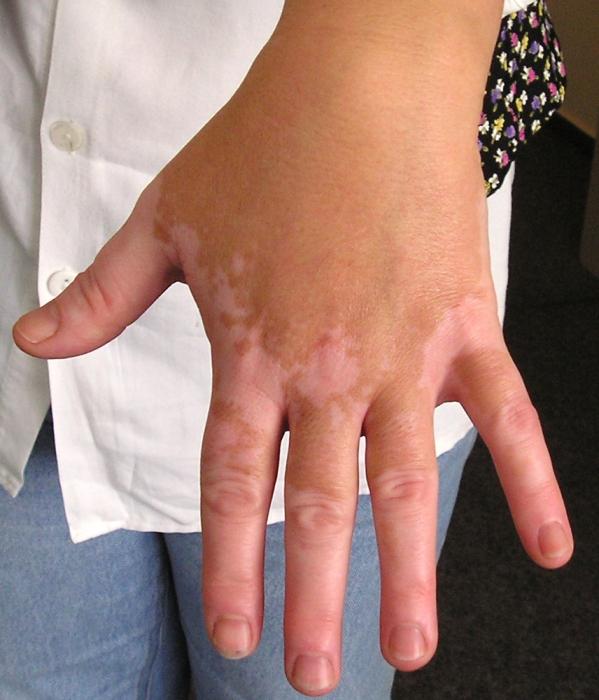 vitiligo-betegség 