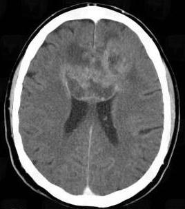 az agy astrocytoma