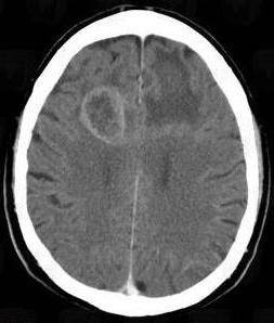 az agy astrocytoma