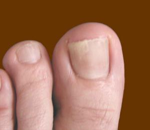 Nail gombák kezelése a lábakon folk jogorvoslatokkal