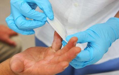 Hogyan kell kezelni a tályogokat az ujjakon: különböző terápiák