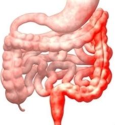 Crohn-betegség fekélyes vastagbélgyulladás