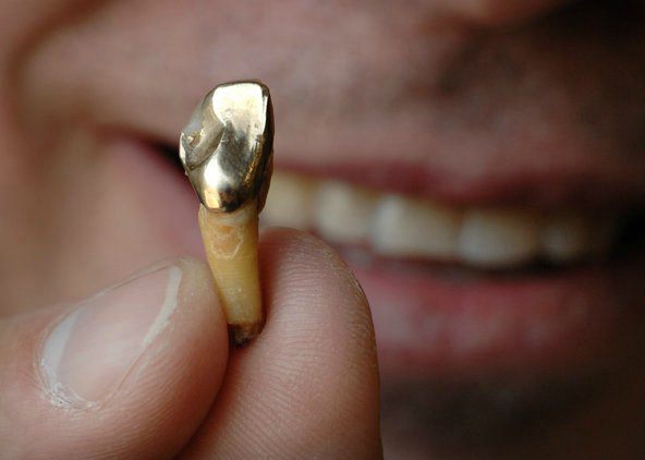 a fogak protetikája nagy számú fogú fénykép hiányában 