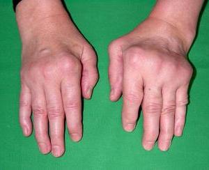 Rheumatoid arthritis (történelem)