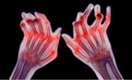 A rheumatoid arthritis hatása