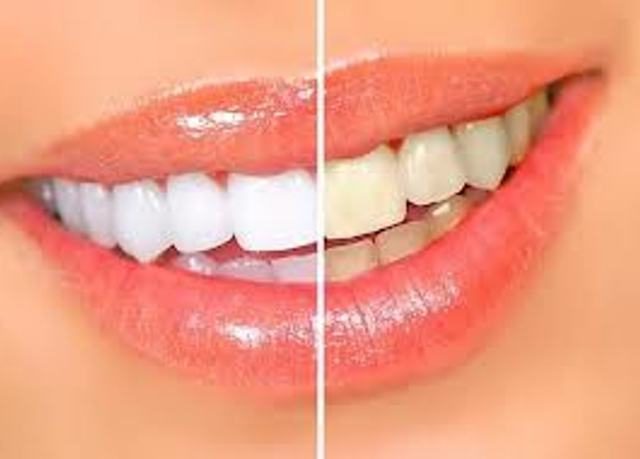 A fogak önhordozó hidrogén-peroxiddal.