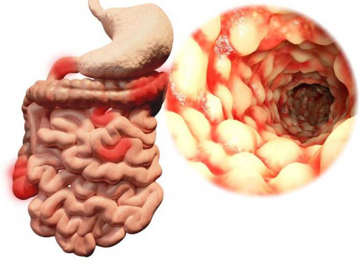 A Crohn-betegség tünetei és kezelése